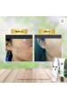 Acne  Pack  Special  (Results : within 7 days)